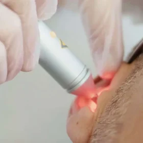 auriculotherapie-au-laser