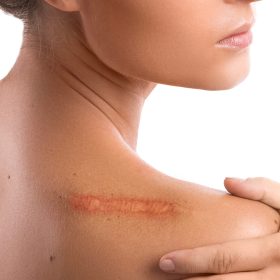 woman-with-scar-her-shoulder-white-background
